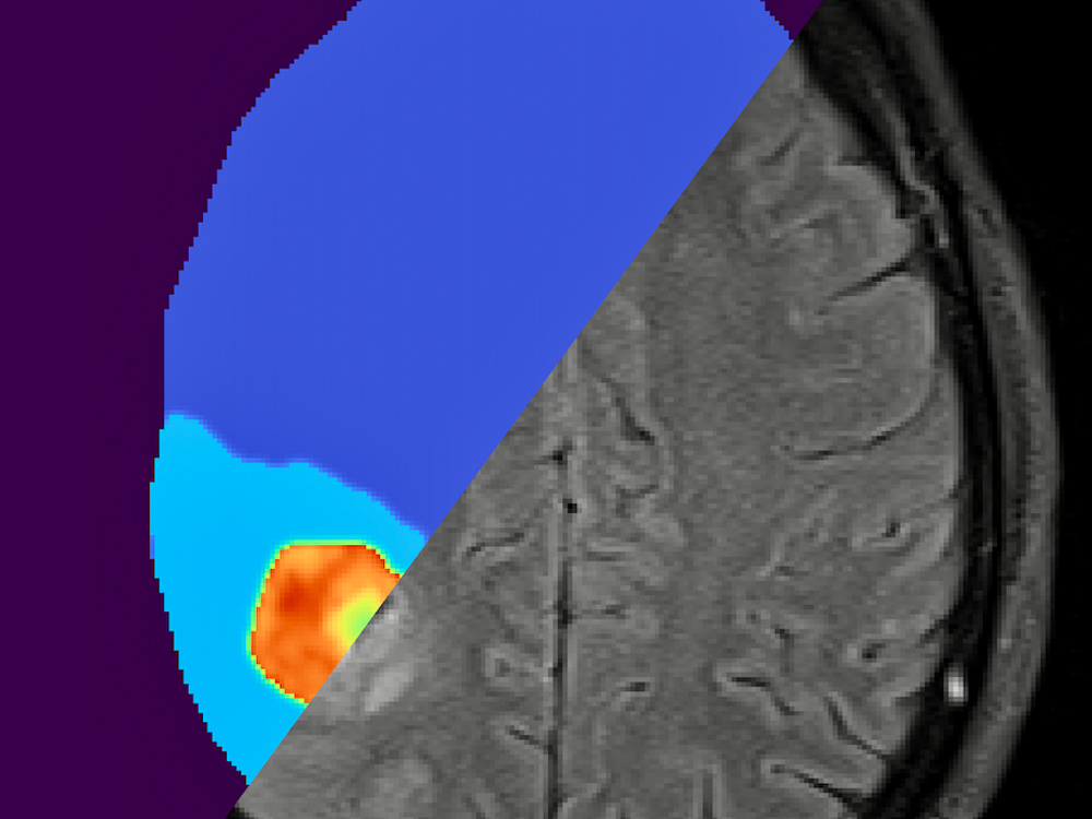 graphic of digital twin brain tumor